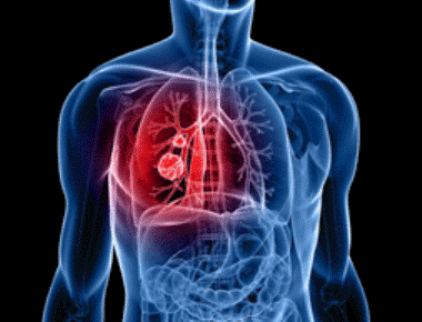 New method to detect lung cancer more accurately
