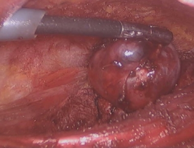 Kasturba Hospital performs Endoscopic Thyroidectomy